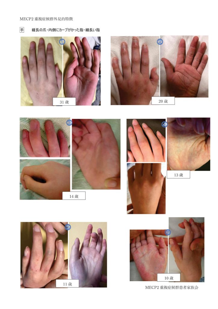 MECP2重複症候群外見的特徴-001