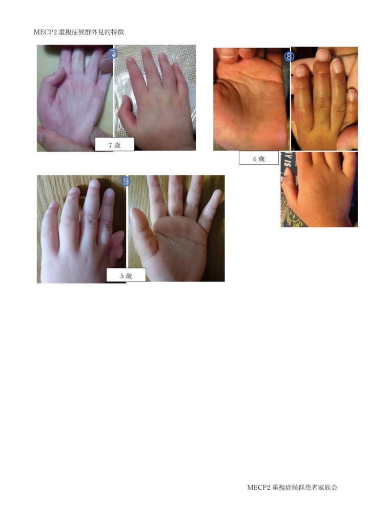 MECP2重複症候群外見的特徴-002