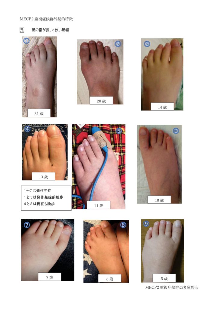 MECP2重複症候群外見的特徴-003